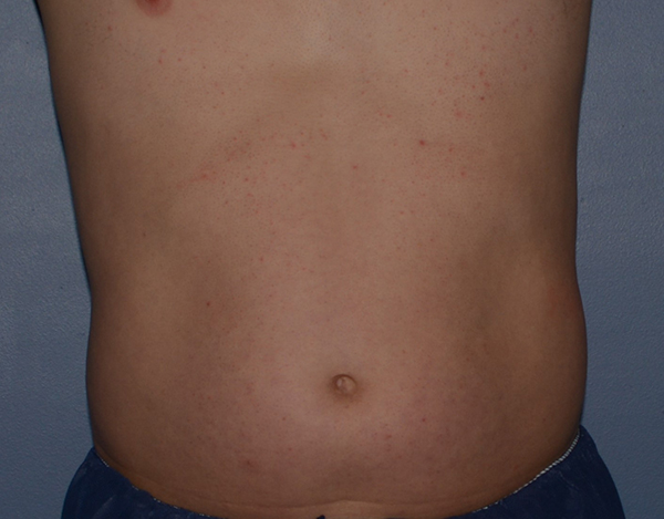 Liposuction