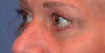Eyelid Lift