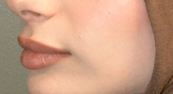 Lip Lift
