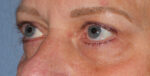 Eyelid Lift