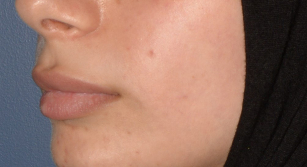 Lip Lift