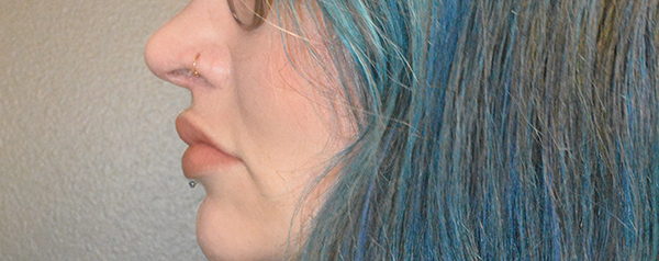 Lip Lift