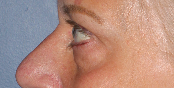 Eyelid Lift