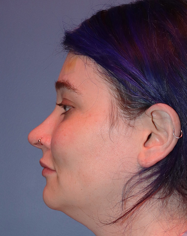 Lip Lift