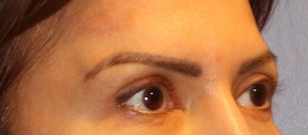Brow Lift
