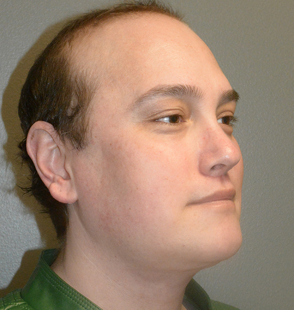 Buccal Fat Removal