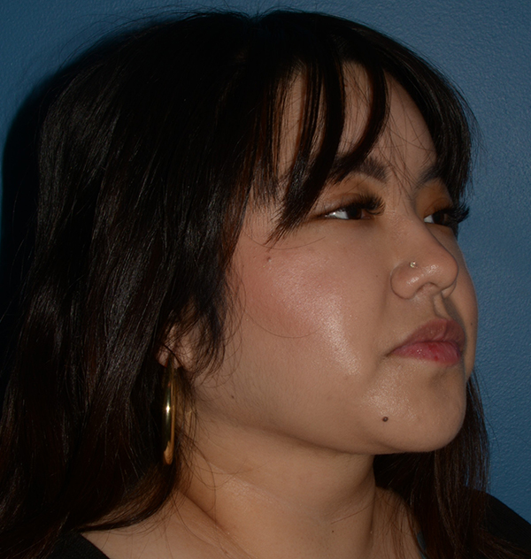 Buccal Fat Removal