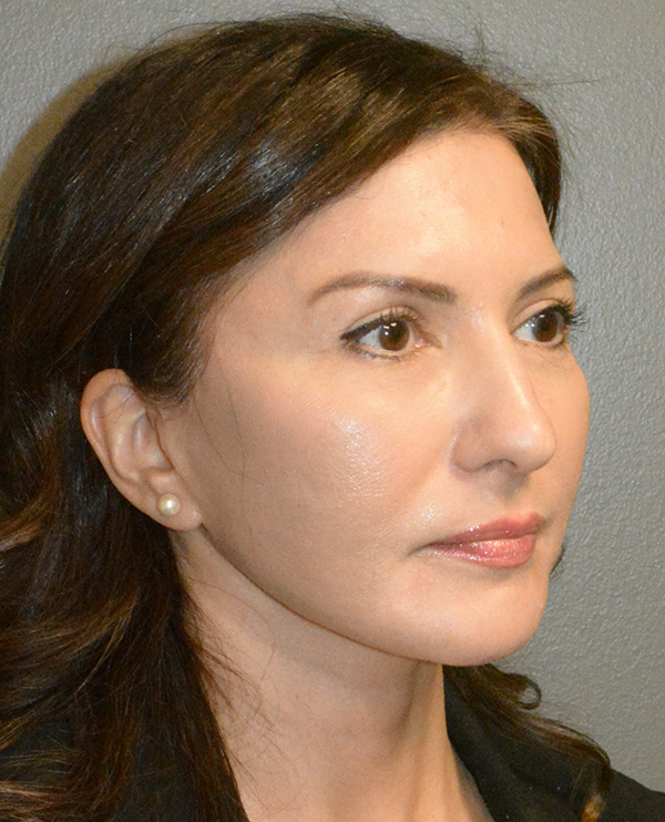 Facelift