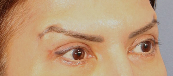 Brow Lift