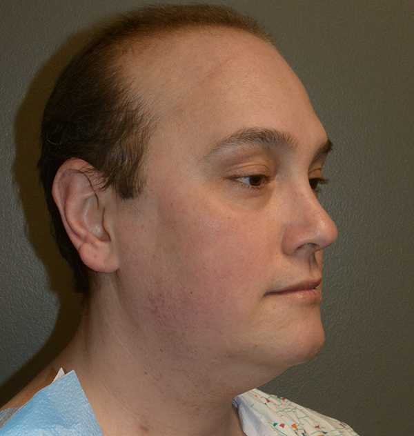 Buccal Fat Removal