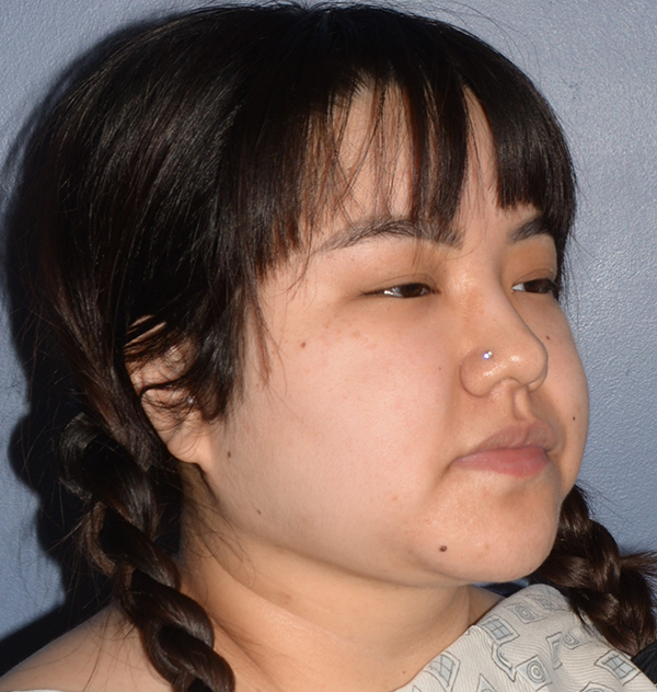 Buccal Fat Removal
