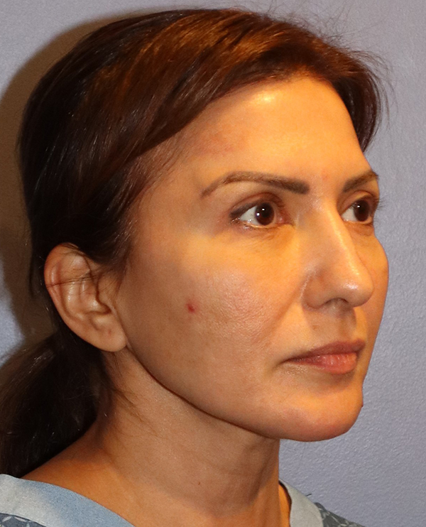 Facelift