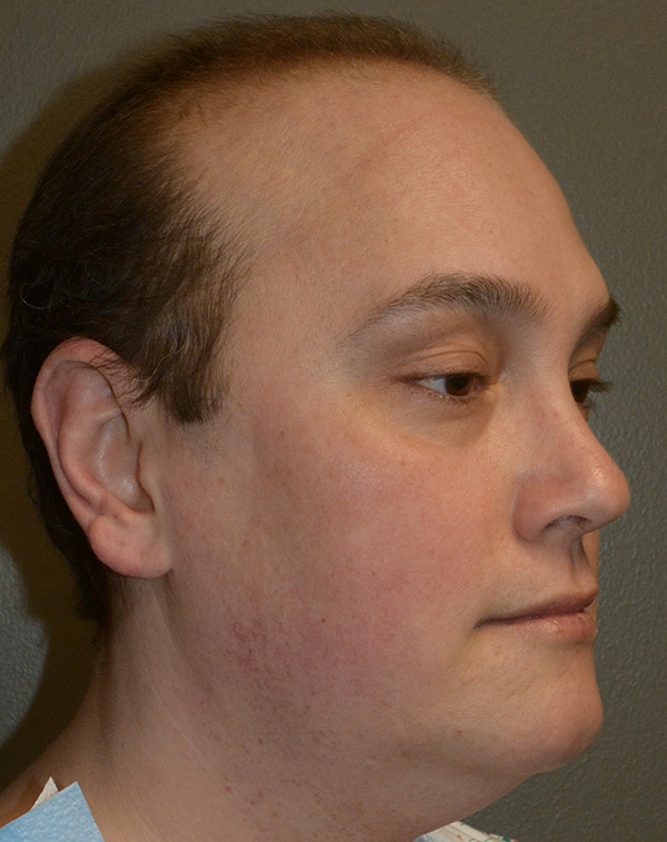Lip Lift