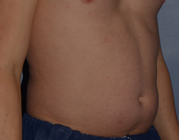 Liposuction
