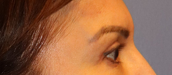 Brow Lift