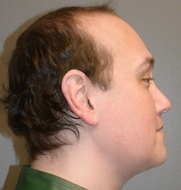 Buccal Fat Removal