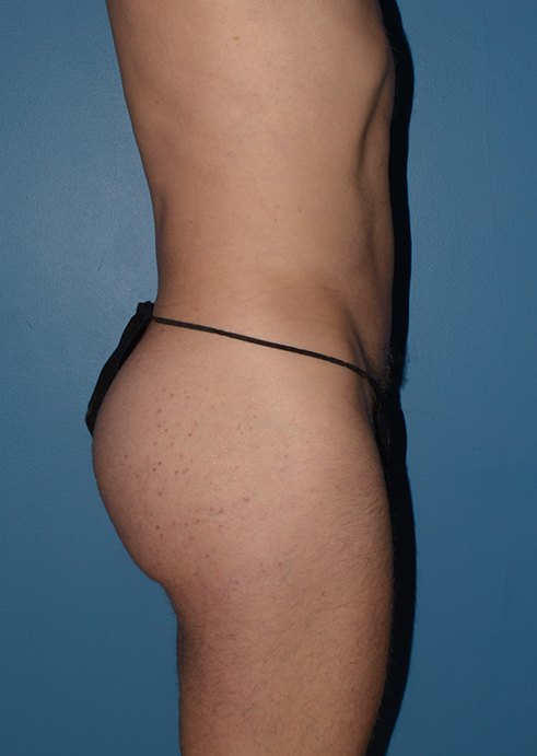 Butt Gluteal Implants