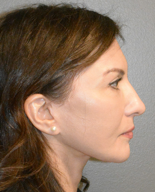 Facelift