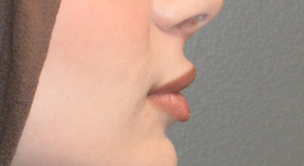 Lip Lift