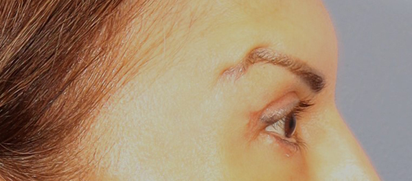 Brow Lift