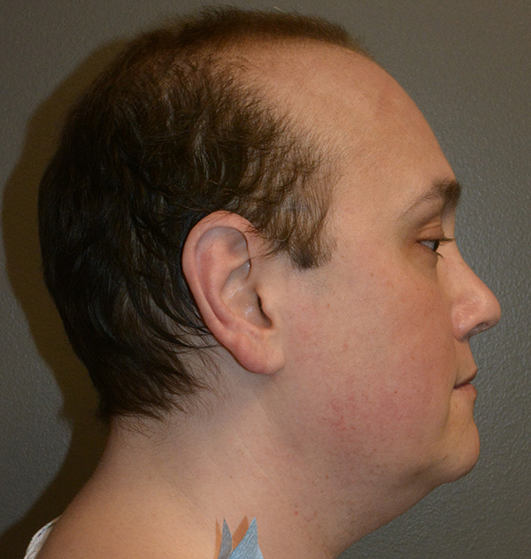 Buccal Fat Removal