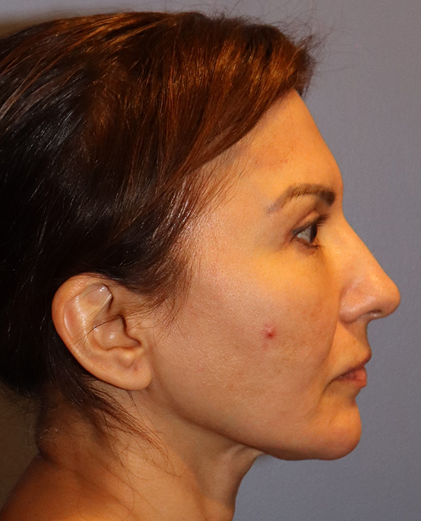 Facelift