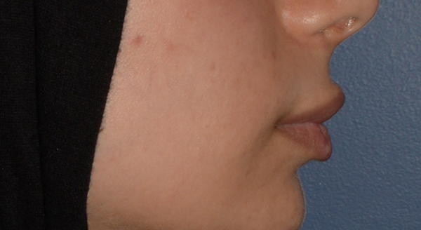Lip Lift