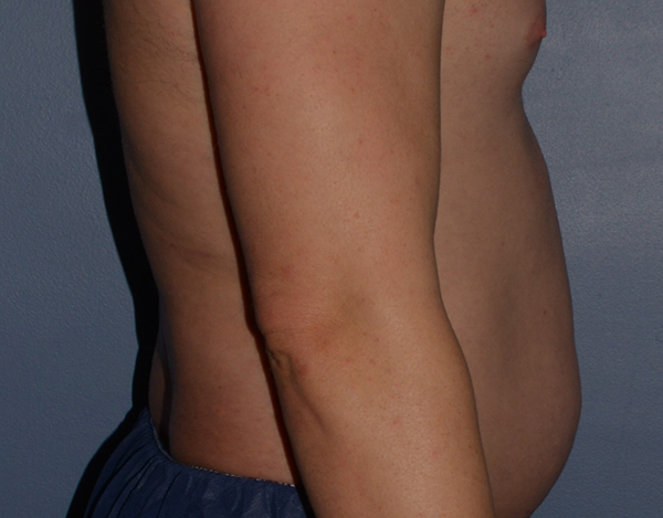 Liposuction
