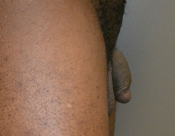 Penile Fat Transfer