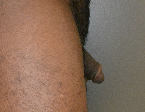 Penile Fat Transfer