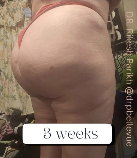 Cellulite Reduction Avéli®