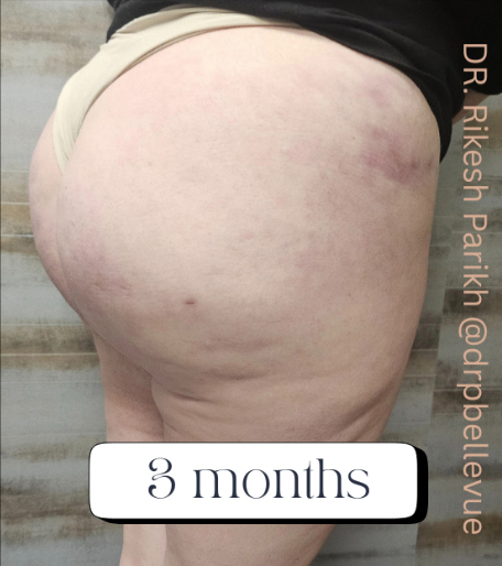 Cellulite Reduction Avéli®