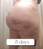 Cellulite Reduction Avéli®