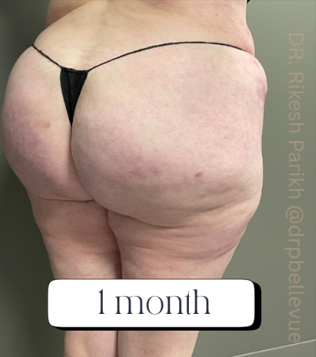 Cellulite Reduction Avéli®
