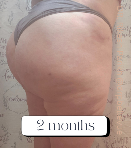 Cellulite Reduction Avéli®