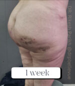 Cellulite Reduction Avéli®