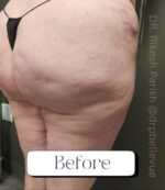 Cellulite Reduction Avéli®