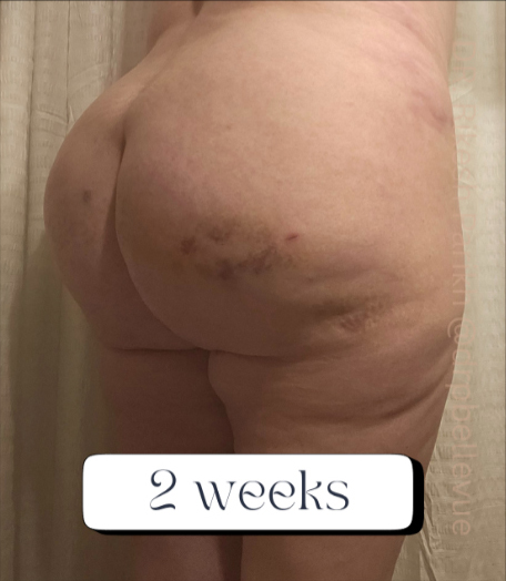 Cellulite Reduction Avéli®
