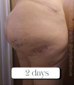 Cellulite Reduction Avéli®