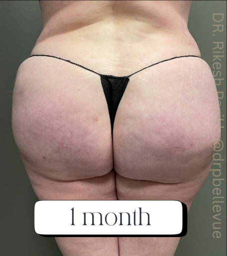 Cellulite Reduction Avéli®