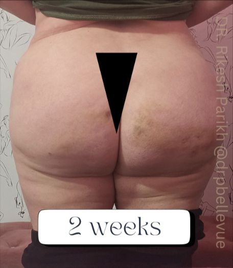 Cellulite Reduction Avéli®