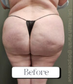 Cellulite Reduction Avéli®
