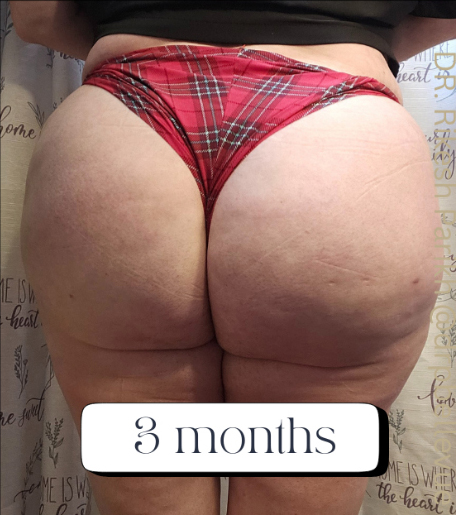 Cellulite Reduction Avéli®