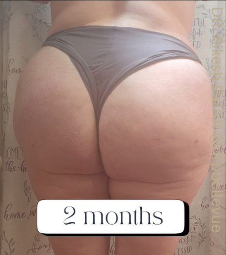Cellulite Reduction Avéli®