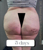 Cellulite Reduction Avéli®