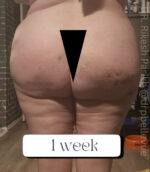 Cellulite Reduction Avéli®