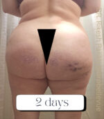 Cellulite Reduction Avéli®