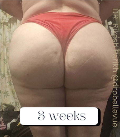 Cellulite Reduction Avéli®