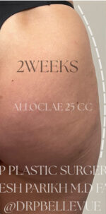 AlloClae™ Structural Donor Fat