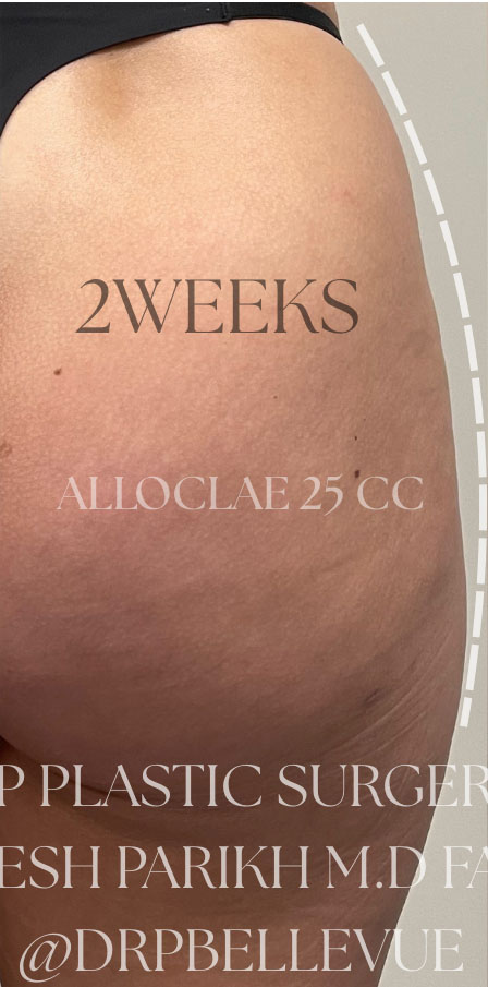 AlloClae™ Structural Donor Fat
